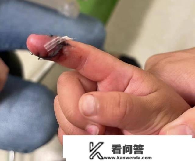 张恒爆料郑爽虐儿，申请美国贫苦白卡，孩子受伤照片曝光