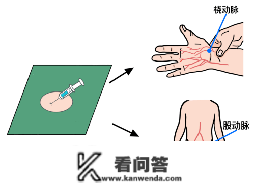 什么是冠脉造影？什么是PCI？什么是心脏收架植入