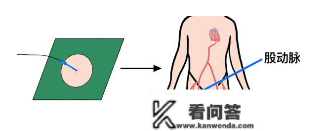 什么是冠脉造影？什么是PCI？什么是心脏收架植入