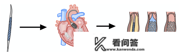 什么是冠脉造影？什么是PCI？什么是心脏收架植入