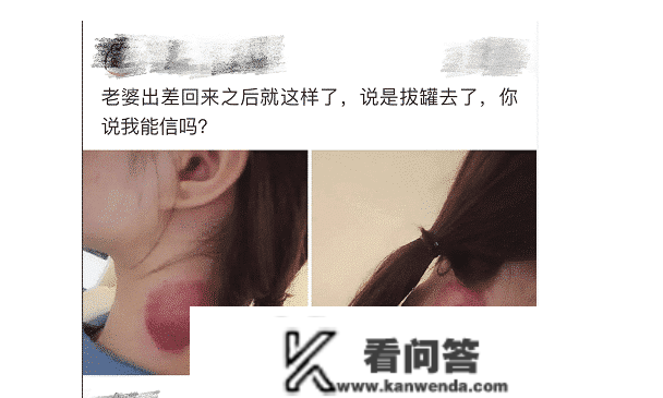 “女友出差回来后脖子有红印，问她说是拔罐了”我该相信她吗？