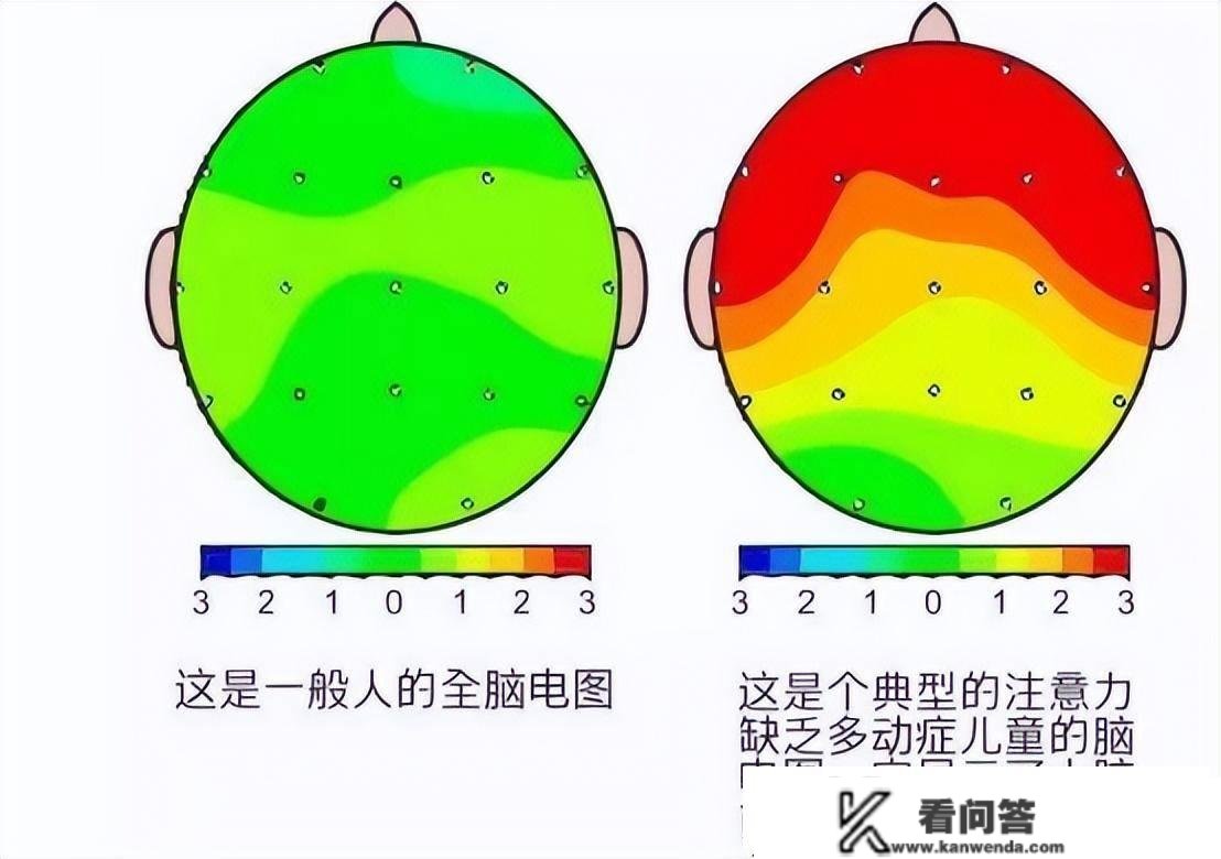 多动症的查抄重点有哪些？干涉办法有哪些？