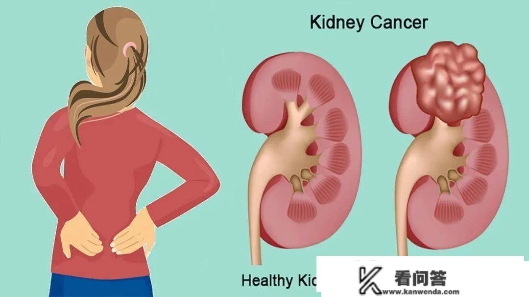 肾癌为什么叫“缄默的杀手”