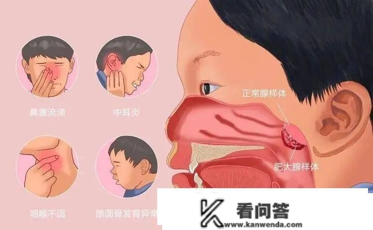 腺样体常识汇：家长怎么准确预防，避免孩子的腺样体炎变肥大？