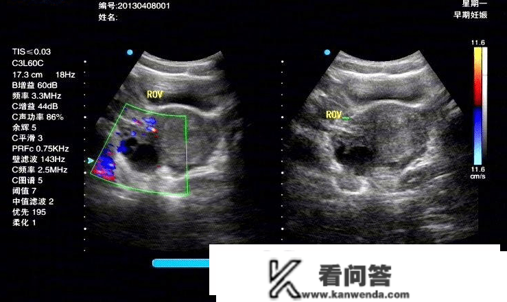 黄体分裂是什么意思？