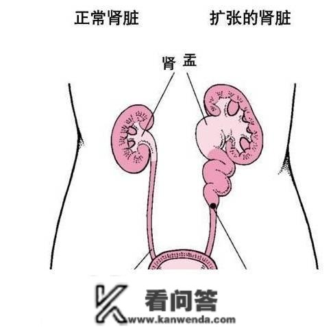 肾结石卡在输尿管怎么办？用那办法排出不积水