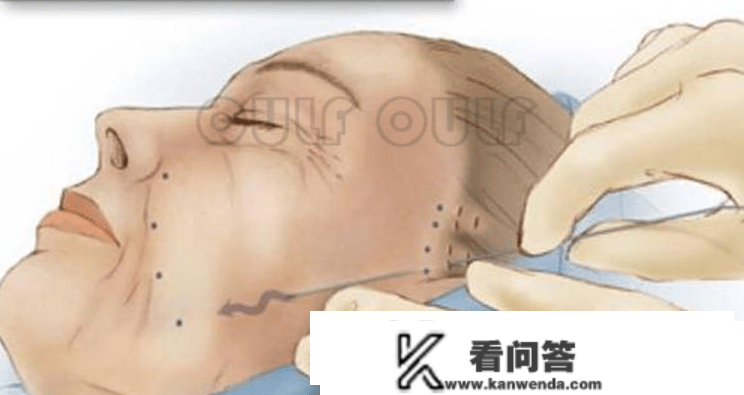 解锁：筋膜固定是什么意思，筋膜提拔是怎么做的~