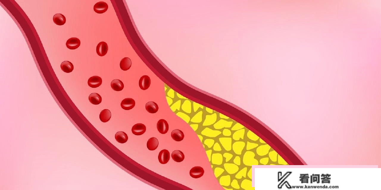 低密度脂卵白，事实是什么？偏高危害大？医生：2个血管查抄要查