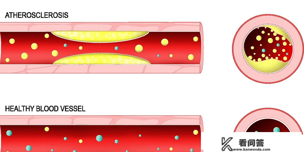 低密度脂卵白，事实是什么？偏高危害大？医生：2个血管查抄要查