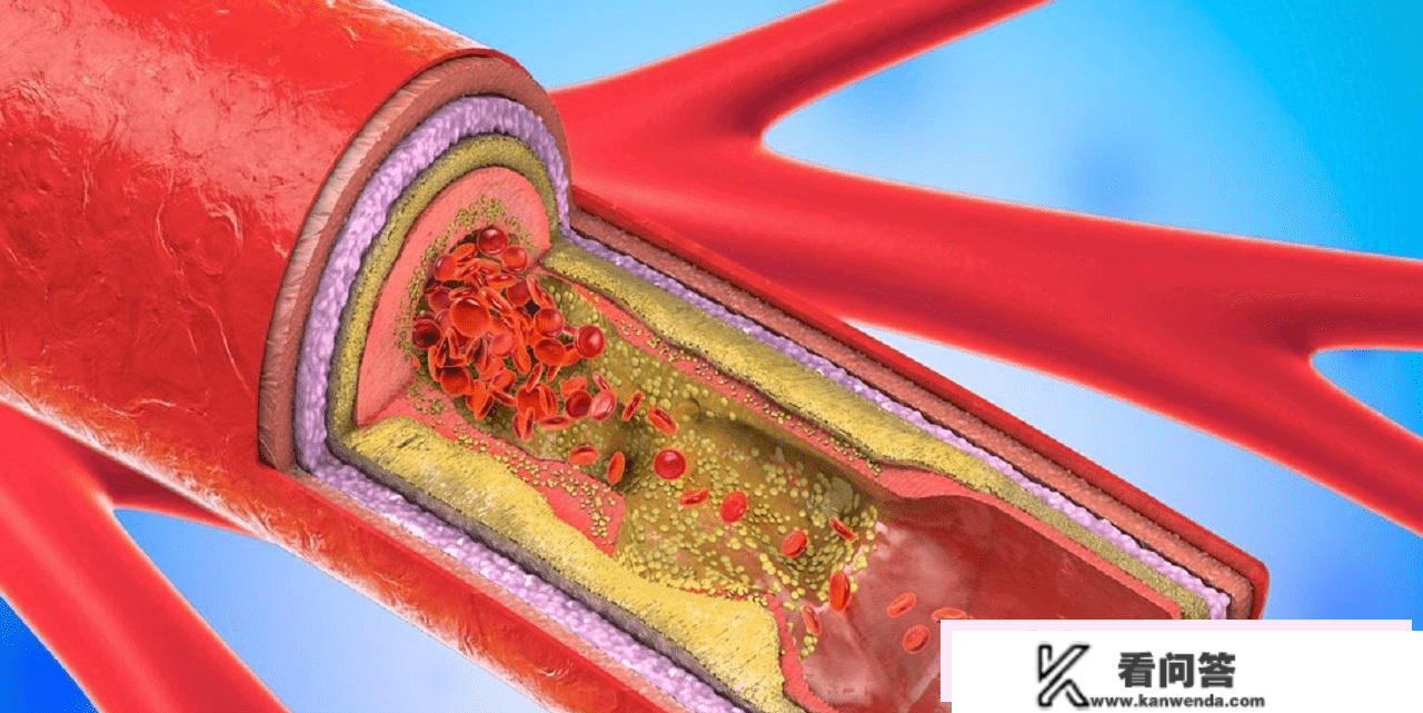 低密度脂卵白，事实是什么？偏高危害大？医生：2个血管查抄要查