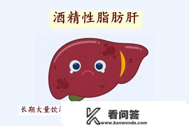 小欣苷安康科普：肝内脂量堆积是什么意思?