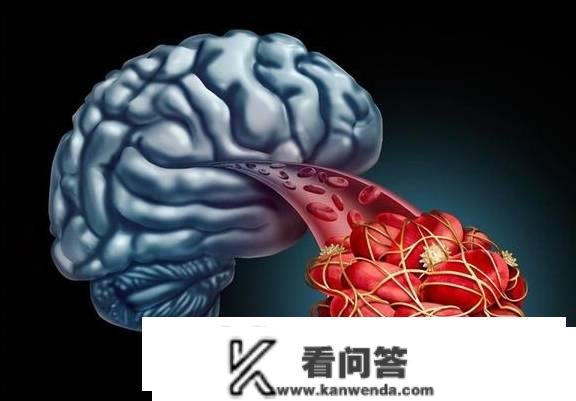 脑梗是“拖”出来的吗？睡觉时如有那3个现象，需要引起重视