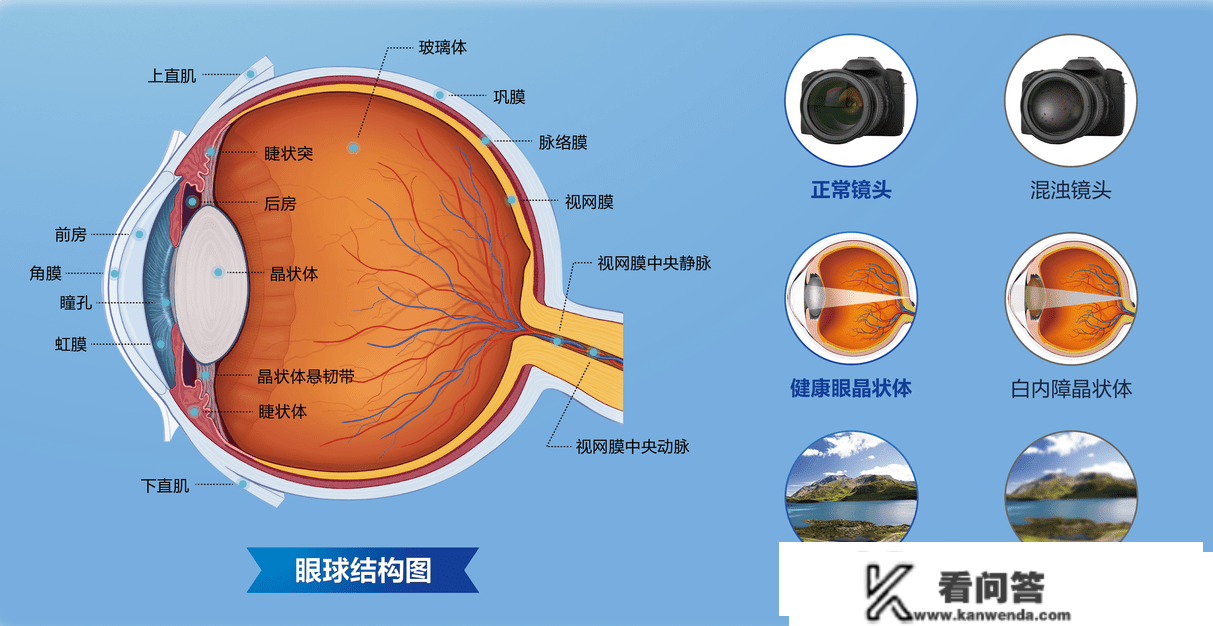 超全面的白内障术前术后常识，你都晓得吗？