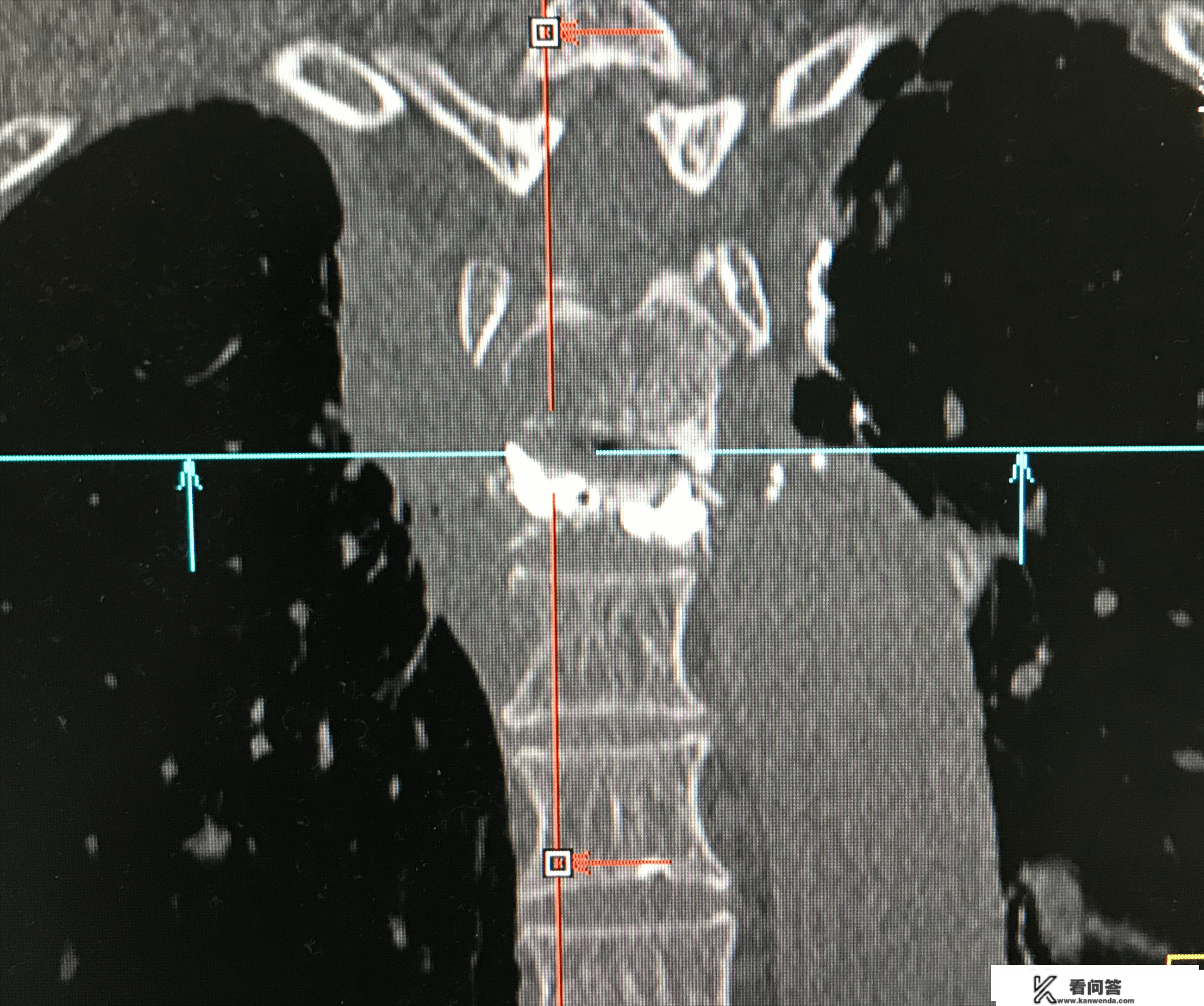 病例Ⅶ：肺癌高位胸椎多椎体转移致重度压缩性骨折RF+PVP结合治疗