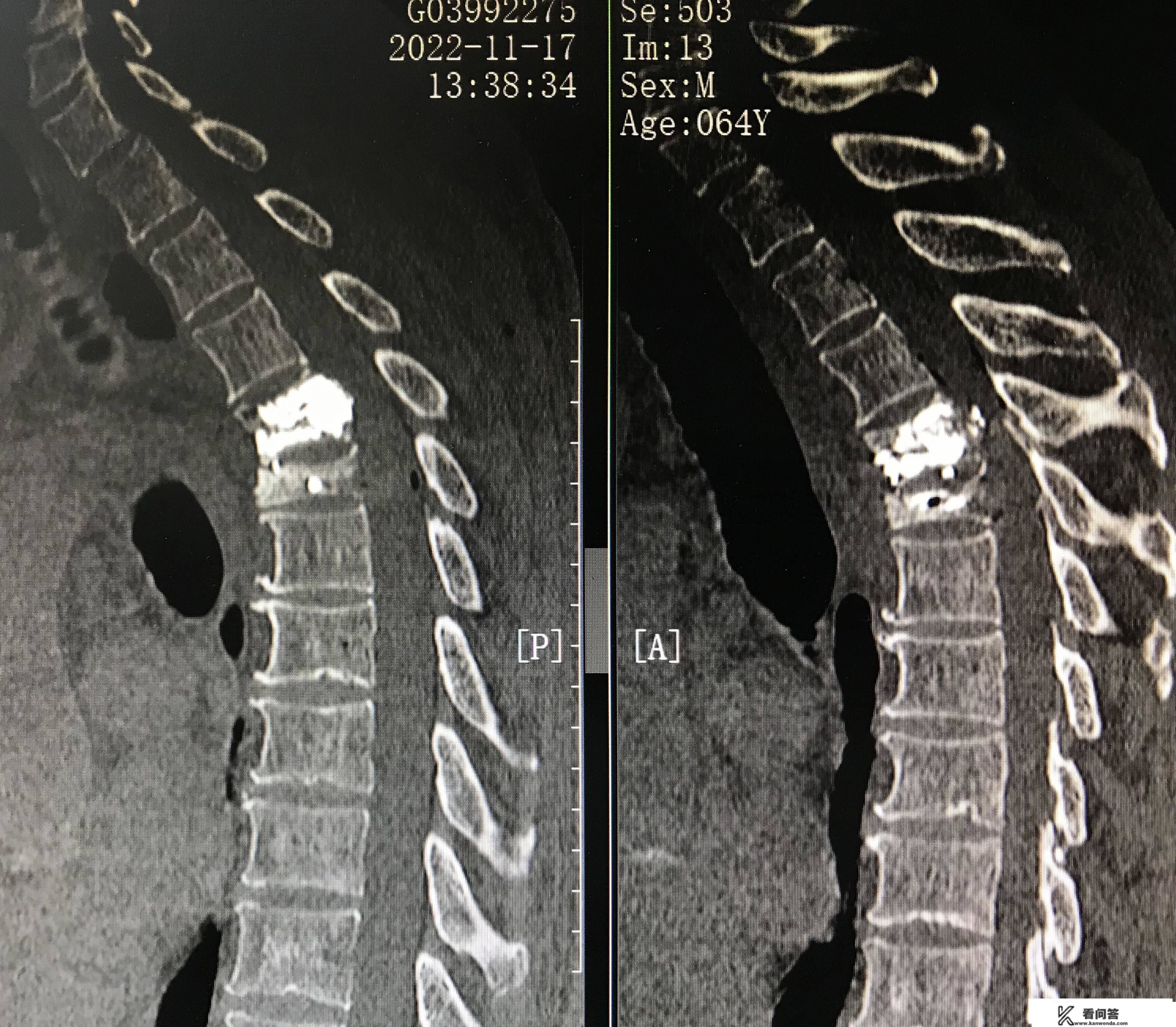 病例Ⅶ：肺癌高位胸椎多椎体转移致重度压缩性骨折RF+PVP结合治疗