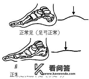 腰椎疾病的自测方式有哪些