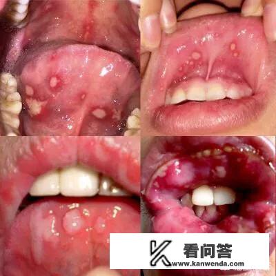 维生素b12能治疗口腔溃疡吗？