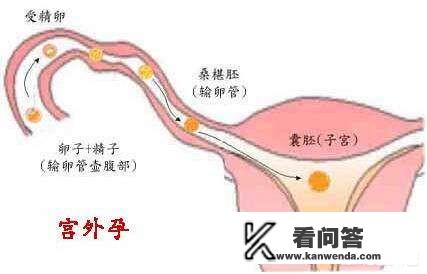 多久B超能检测出是宫内还是宫外孕？