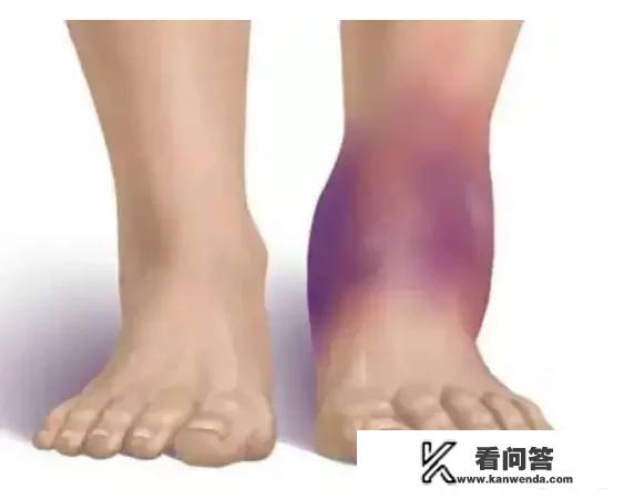 欧冠：皇马输球又输人，维尼修斯关节韧带撕裂，将休养两个月，皇马输在运气吗？