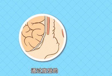 疝气怎么回事？